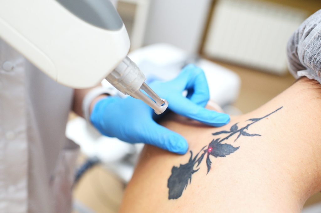 cosmetologist removes the tattoo to the patient using a neodymium laser in a modern clinic. Hardware