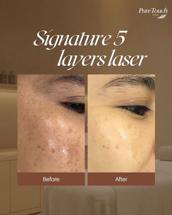 Signature 5 layer laser before after image