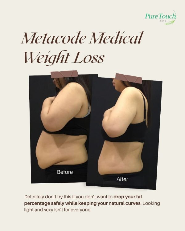 metacode medical weight loss