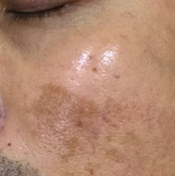 puretouch-pigmentation5 (3)