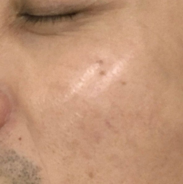 puretouch-pigmentation5 (4)