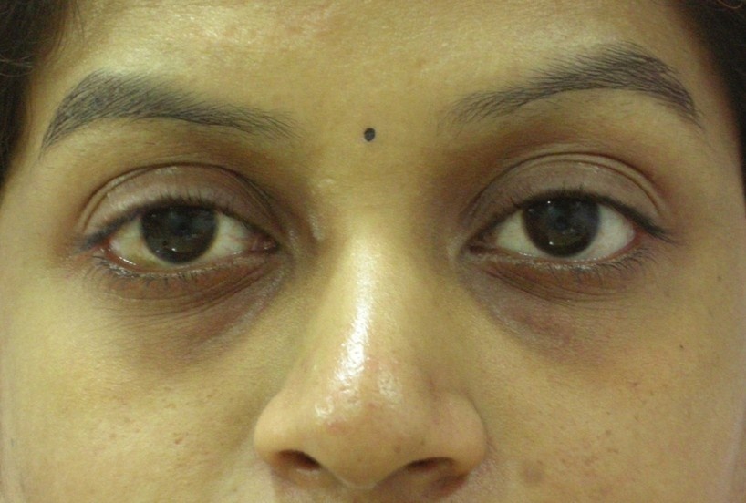 tear through deformity