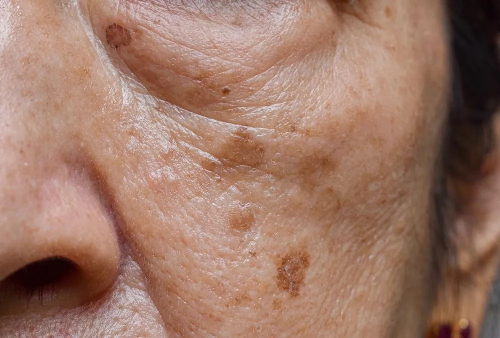 Age spot 2