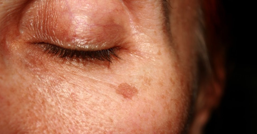 Age Spots Prevention and Treatment for Middle-Aged Skin Featured Image
